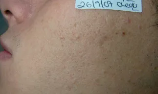 After - Before and after acne treatment at Mode Laser Skin Clinic