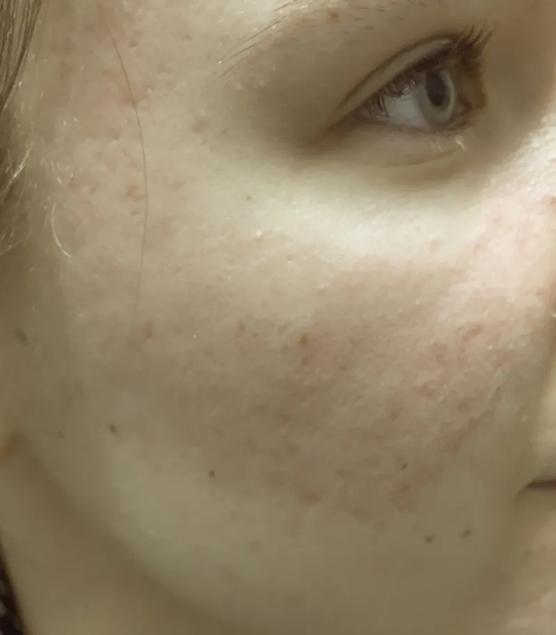 After - Before and after acne treatment showing clearer skin