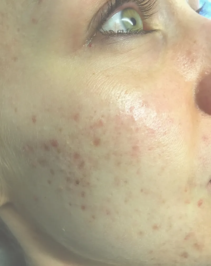 Before - Before and after acne treatment showing clearer skin