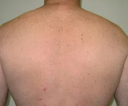 Smooth skin after laser hair removal