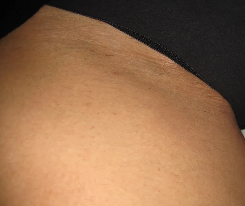 Bikini area after laser hair reduction