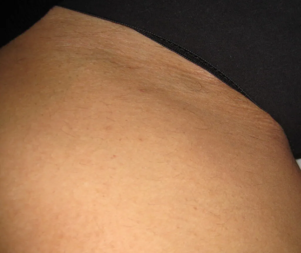 Bikini area after laser hair removal