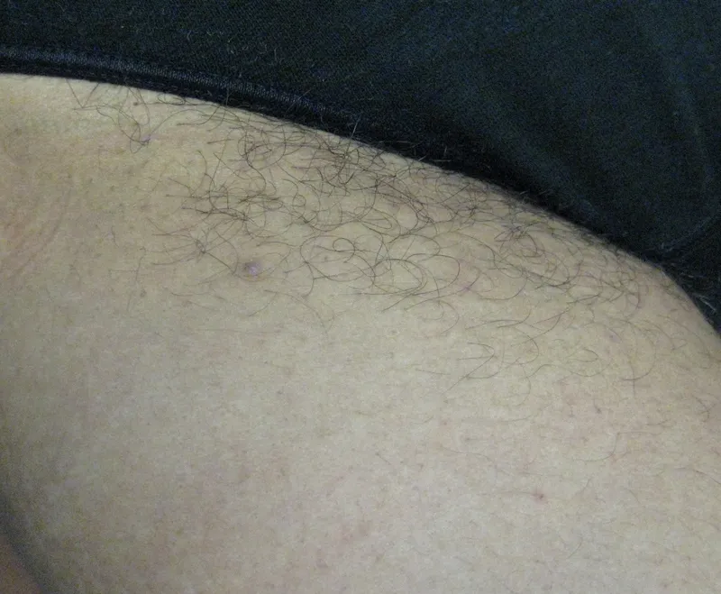 Bikini area before laser hair reduction