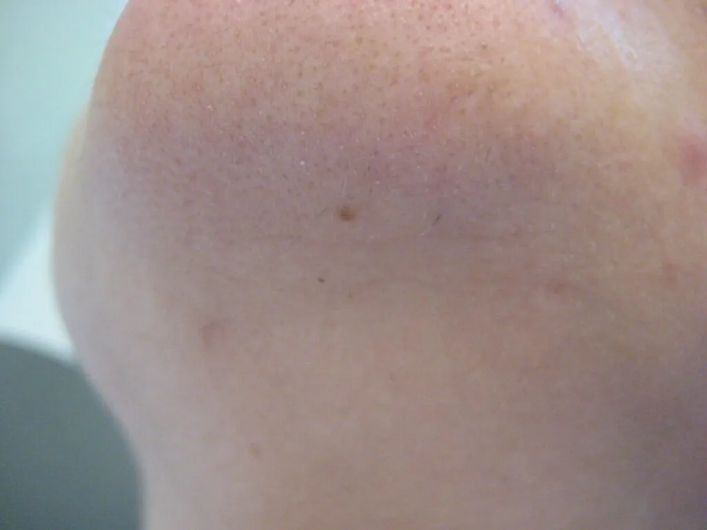 Chin after 6 sessions of IPL hair reduction