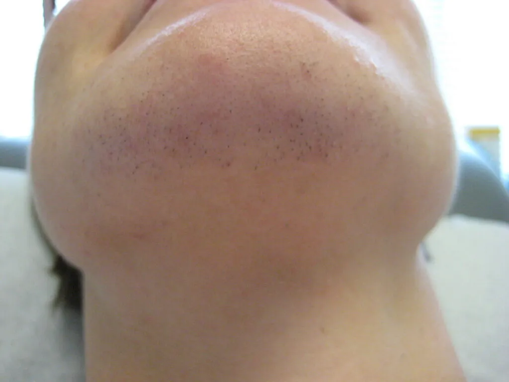 Chin hair before treatment