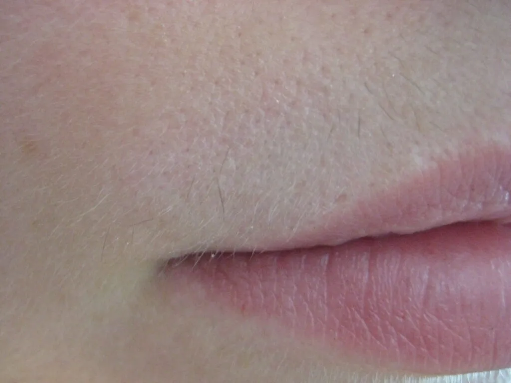 Upper lip after 7 treatments
