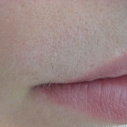 After - Before and after showing lip hair removal results at Mode Laser Skin Clinic