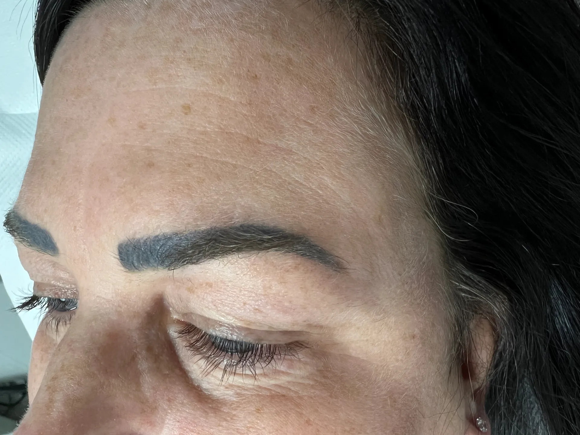 After - Before and after eyebrow tattoo and microblading removal at Mode Laser Skin Clinic