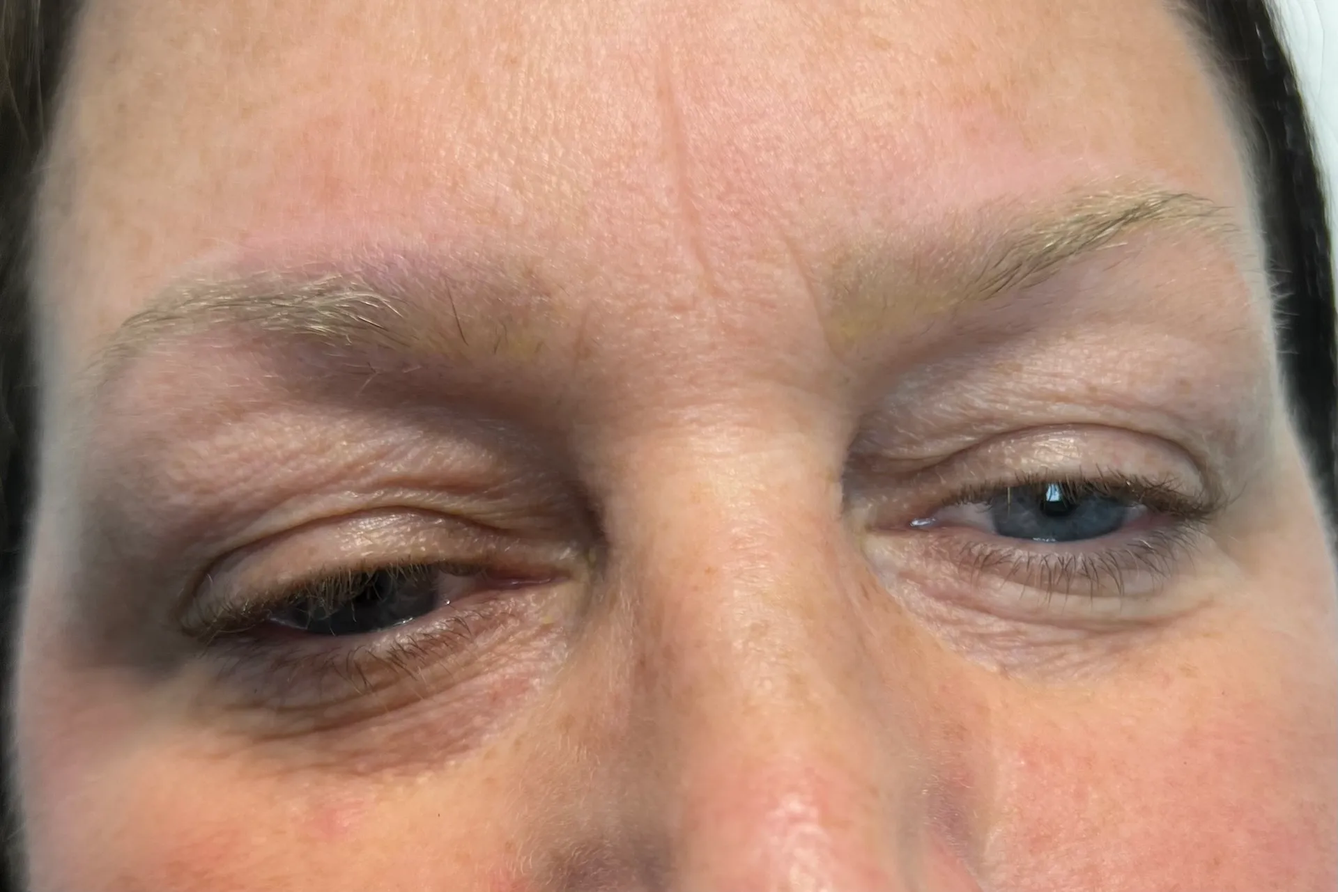 Before - Before and after microblading tattoo removal treatment at Mode Laser Skin Clinic showing natural brow enhancement