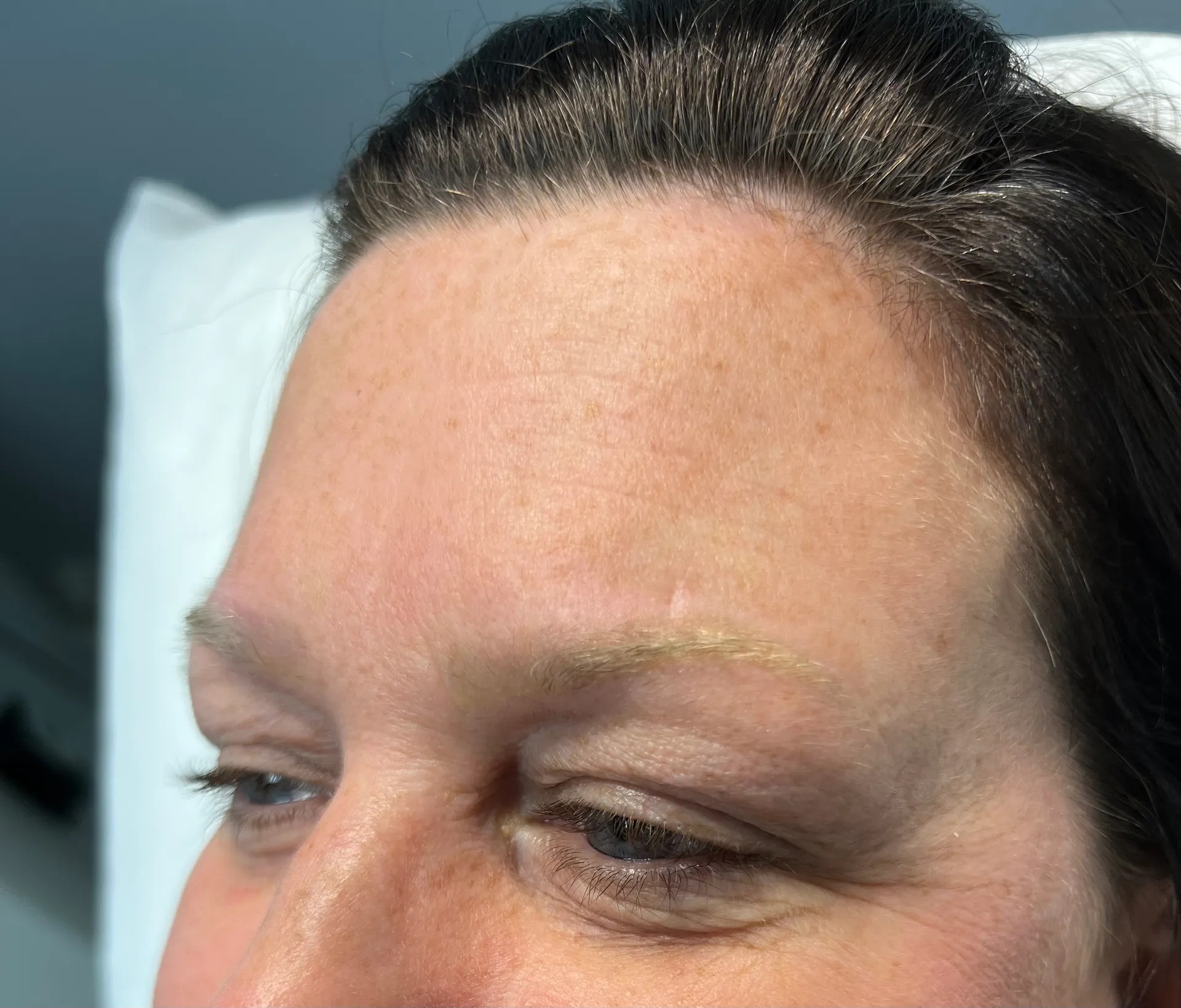 Before - Before and after microblading tattoo removal at Mode Laser Skin Clinic showing fuller, defined brows
