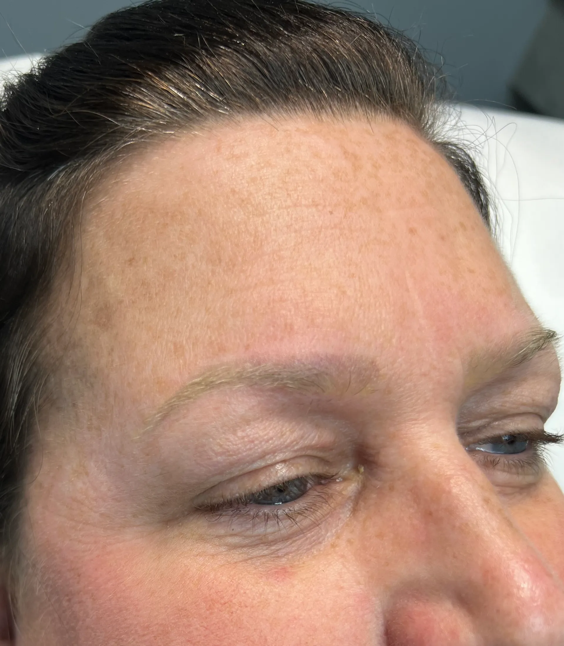 Before - Before and after eyebrow tattoo and microblading removal at Mode Laser Skin Clinic