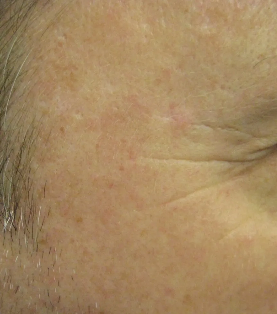 Clear skin after just 1 session