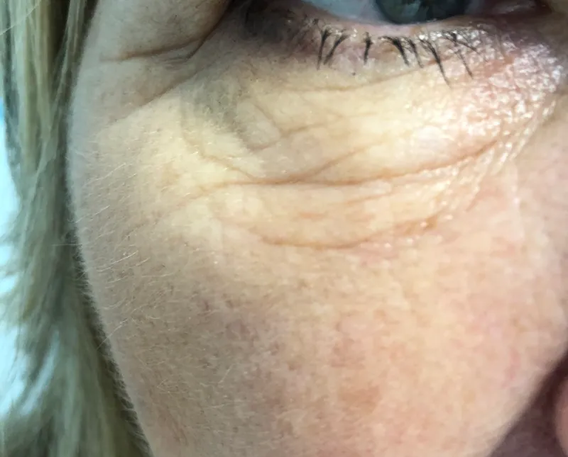 After pigmentation treatment