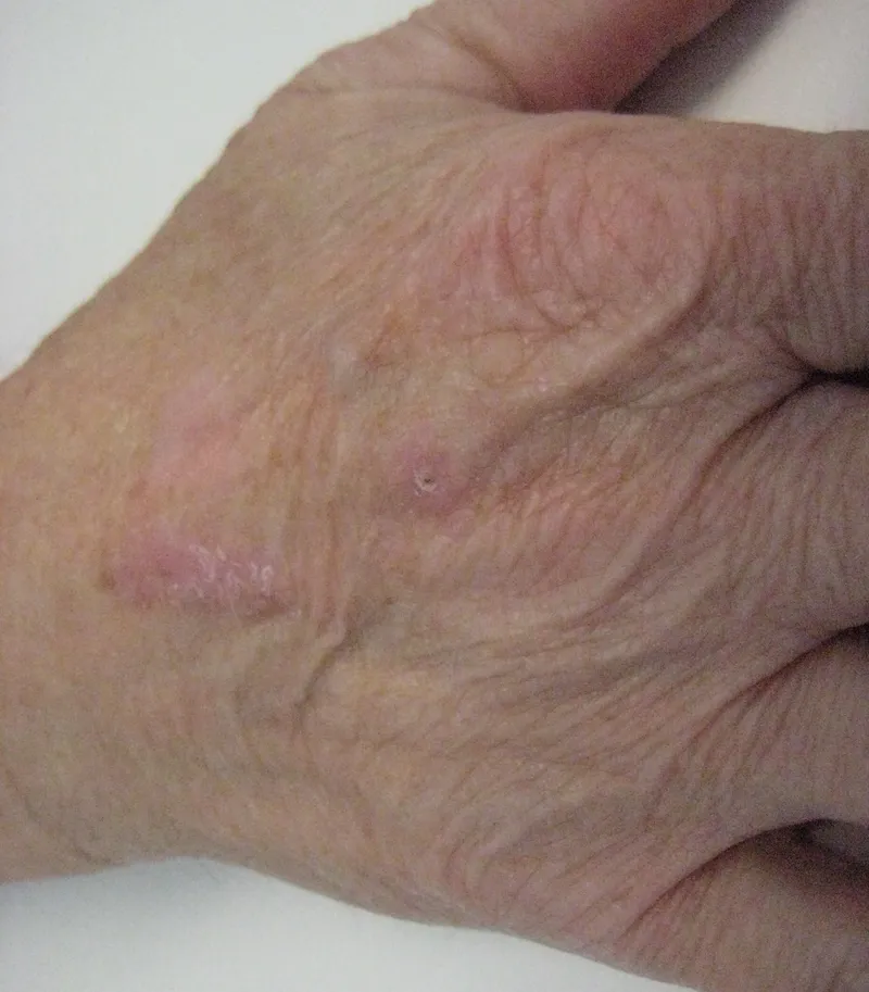 After - Before and after pigmentation treatment at Mode Laser Skin Clinic