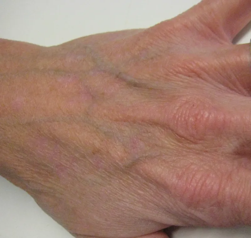 After - Before and after pigmentation removal at Mode Laser Skin Clinic