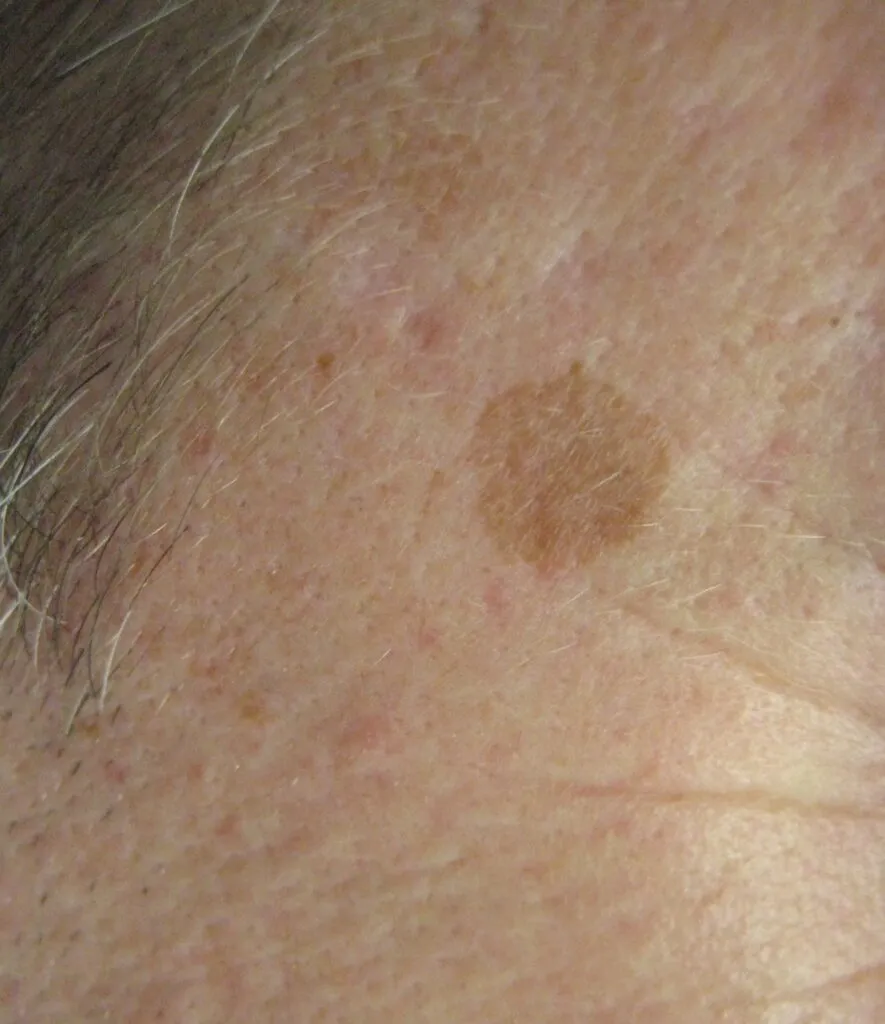 Sun damage before treatment