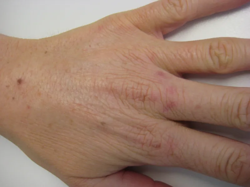 Pigmentation before removal