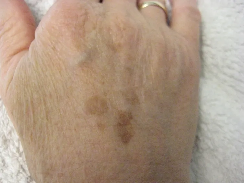 Before - Before and after pigmentation treatment at Mode Laser Skin Clinic