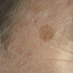 Before - Before and after showing faded pigmentation at Mode Laser Skin Clinic