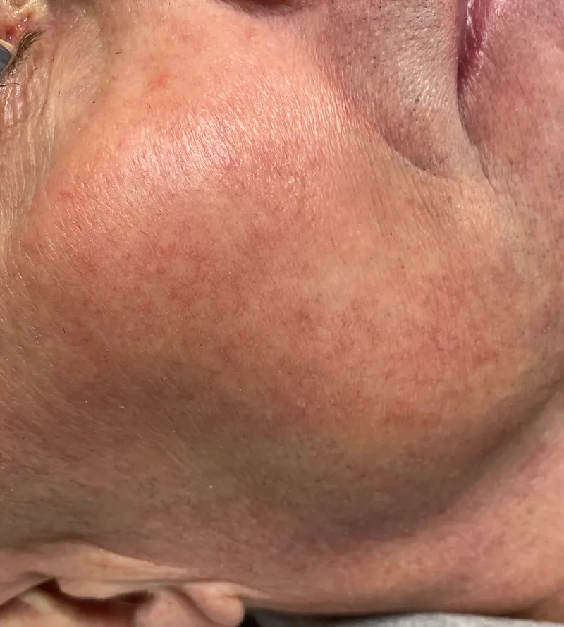 After - Before and after capillary treatment showing cleared skin