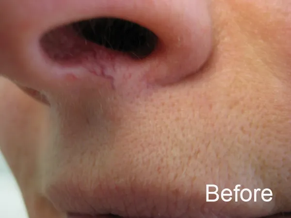 Visible red veins before treatment