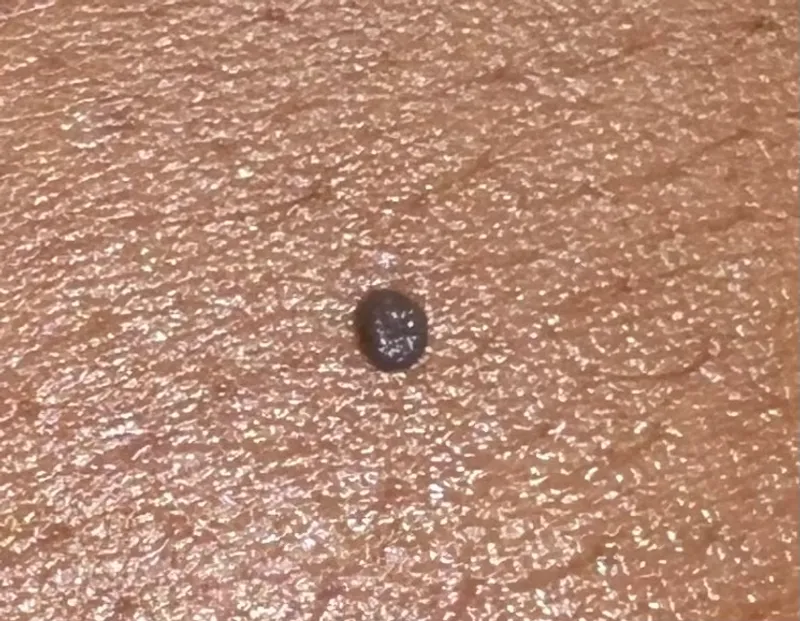 Skin tag before removal