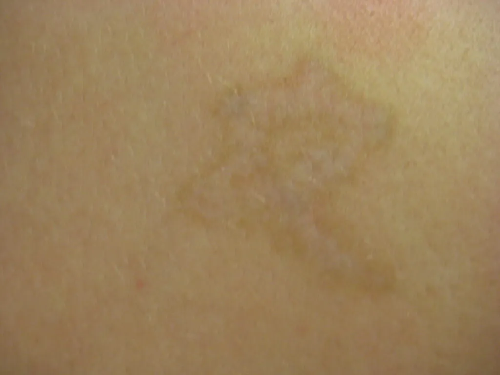 Tattoo significantly faded after 6 sessions