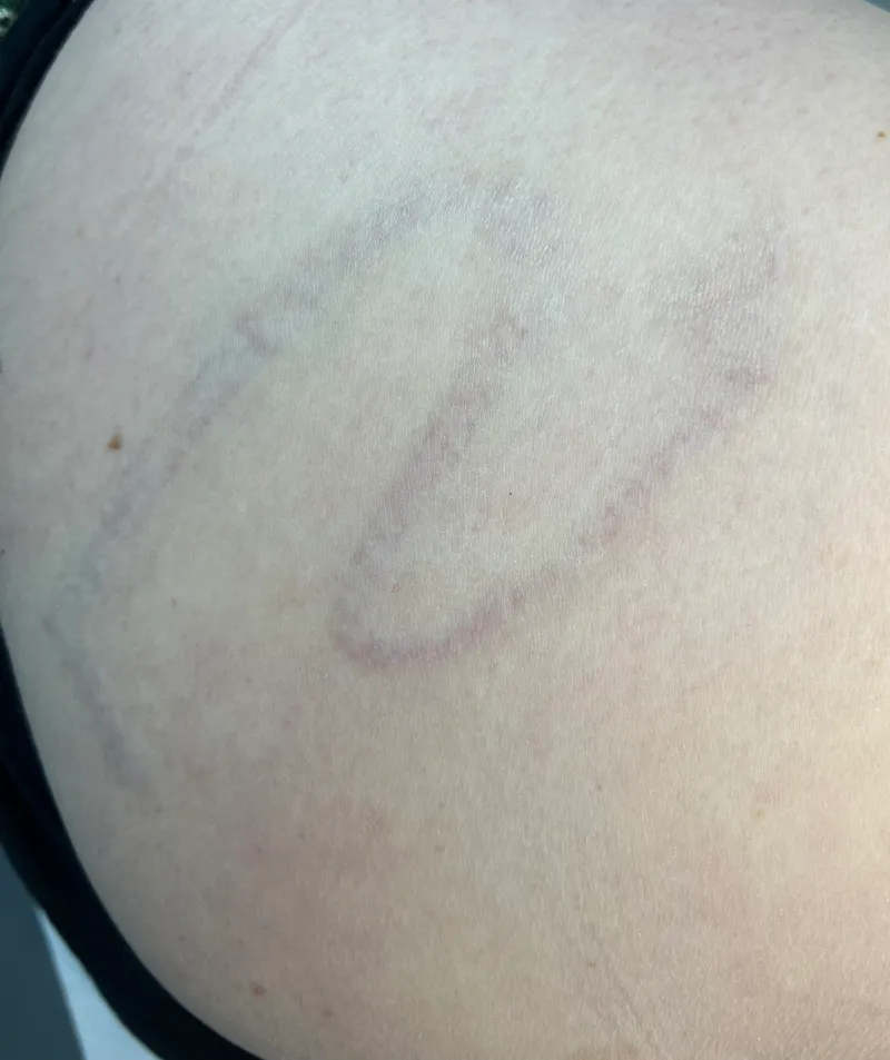 After - Before and after tattoo removal showing significant fading after 11 sessions