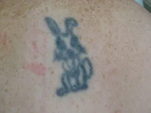 Tattoo before laser removal treatment