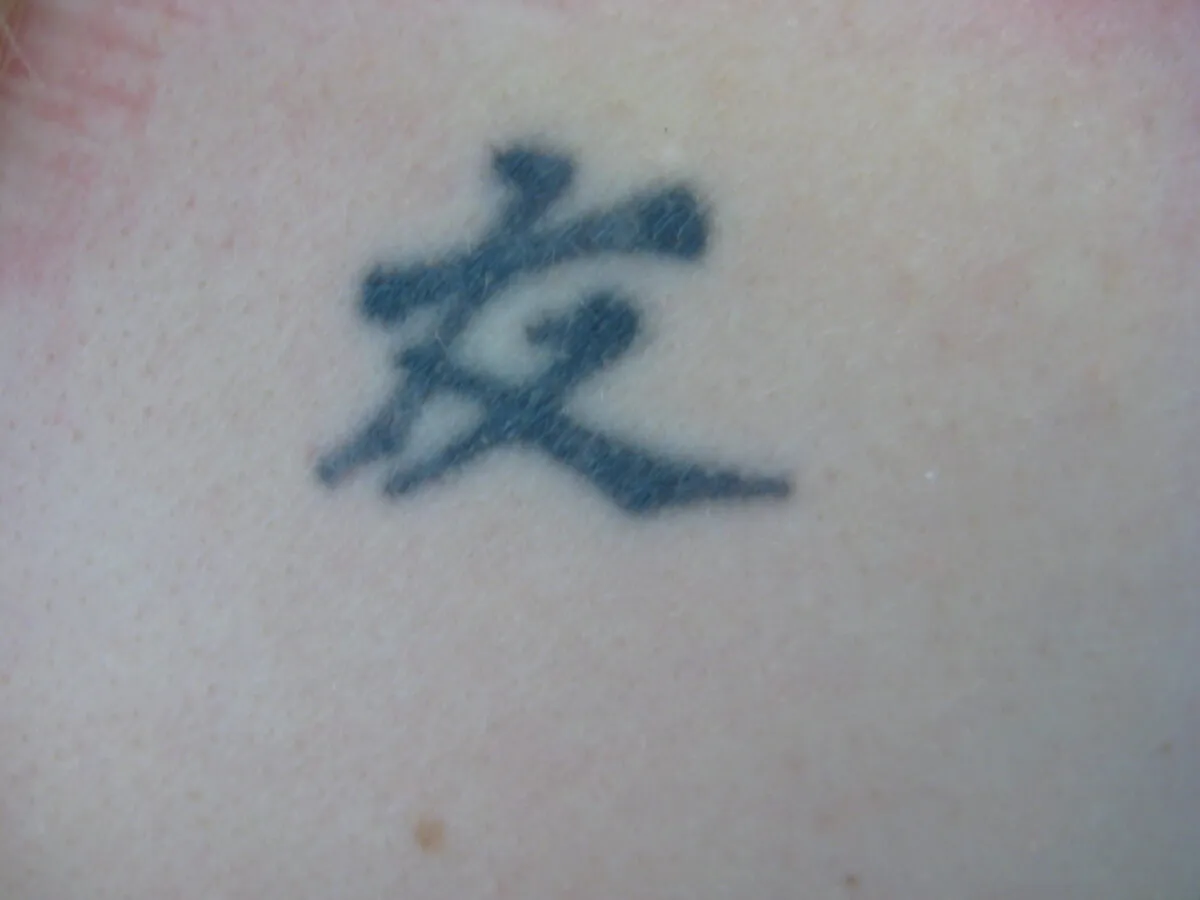 Dark tattoo before removal