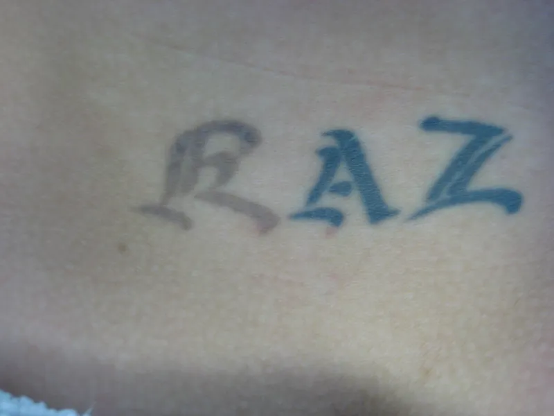 Before - Before and after tattoo removal showing progress after 4 sessions