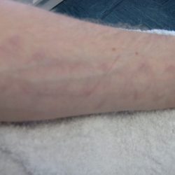 After - Before and after showing complete tattoo removal at Mode Laser Skin Clinic