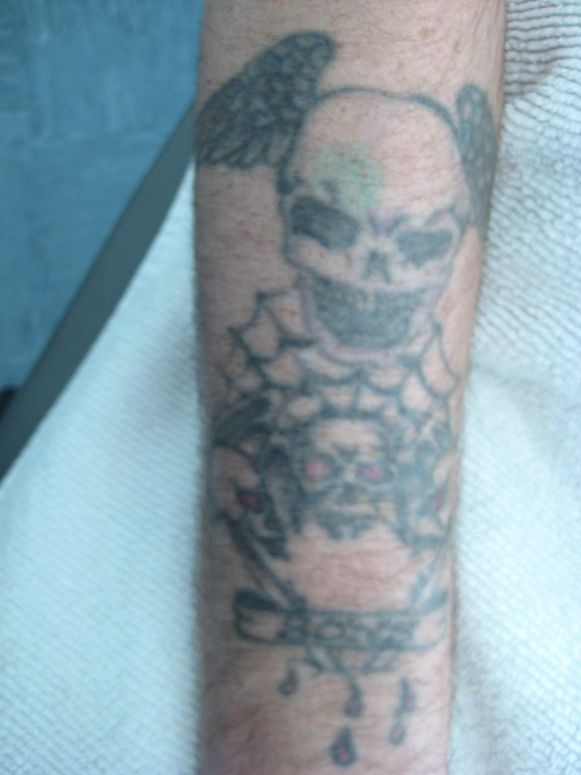 Before - Before and after tattoo removal at Mode Laser Skin Clinic showing complete removal