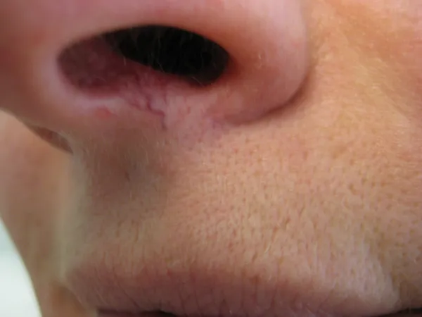Before - Before and after IPL capillary removal treatment at Mode Laser Skin Clinic