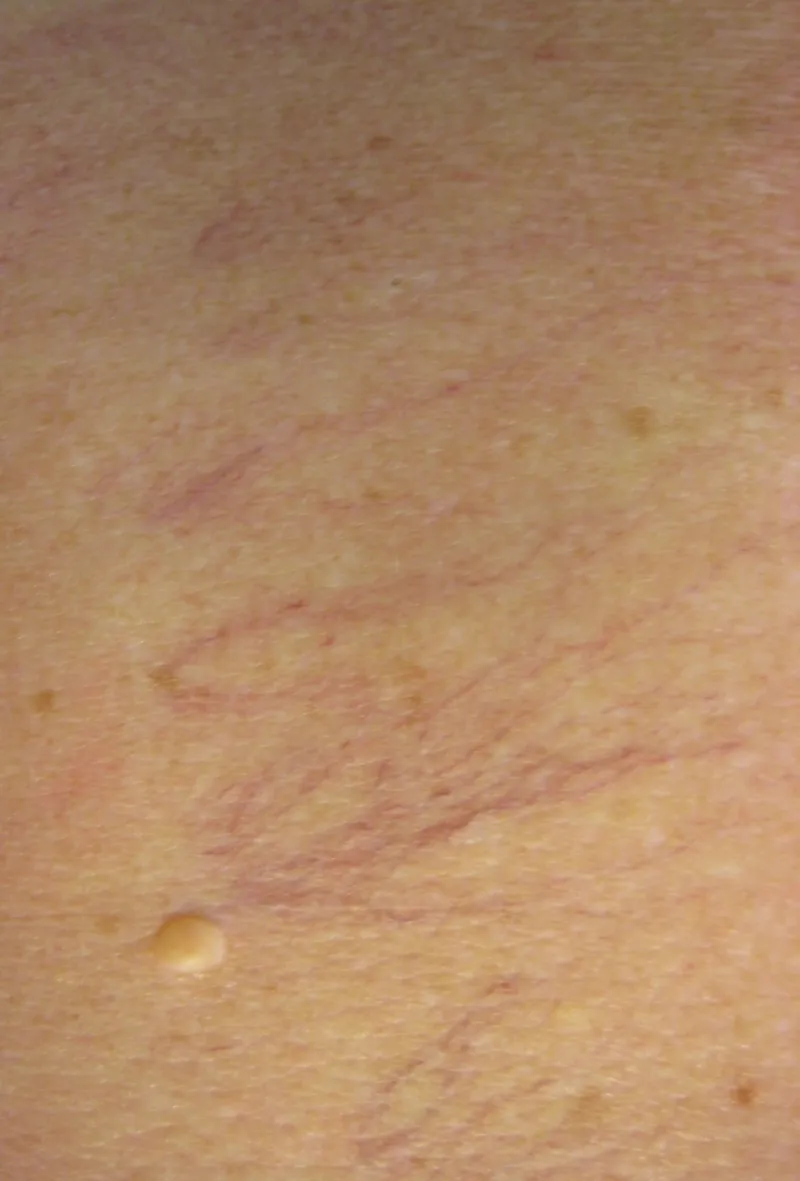 Before - Before and after vascular thread vein treatment at Mode Laser Skin Clinic
