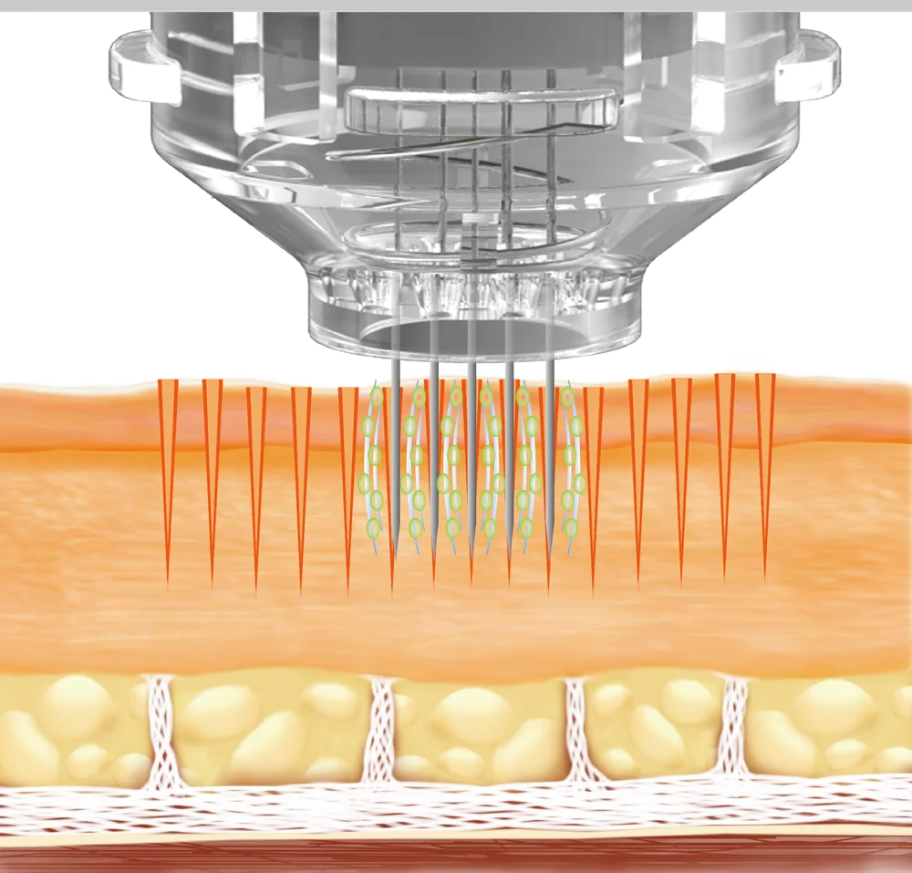 EPN Pen Microneedling skin diagram showing treatment process