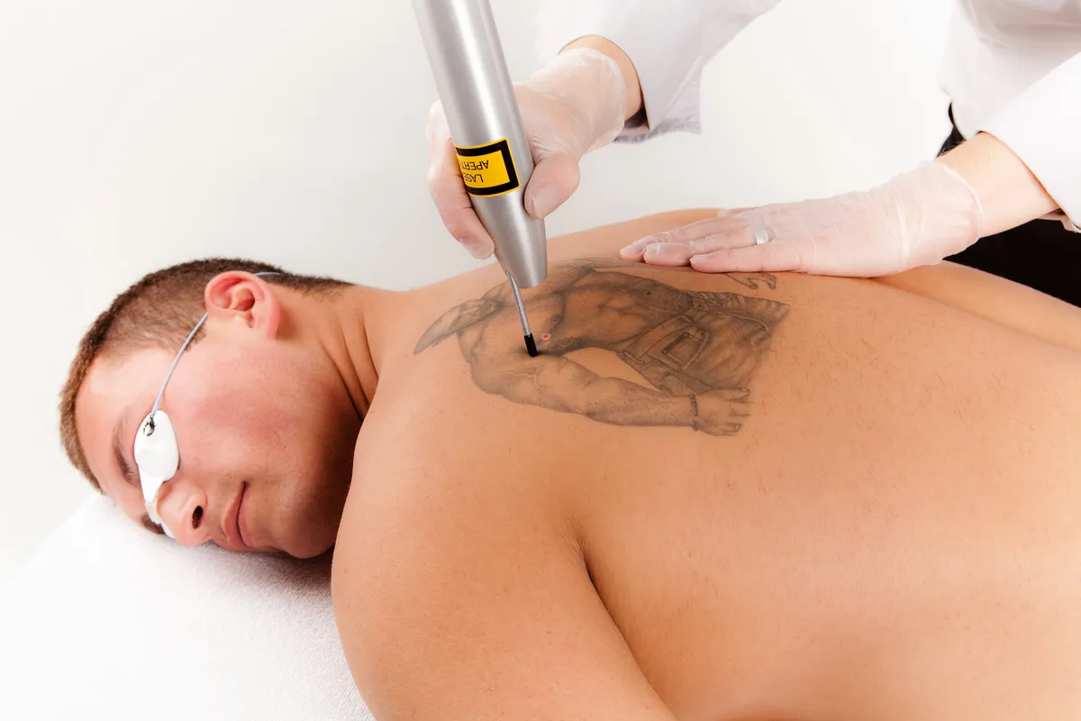 Tattoo Removal